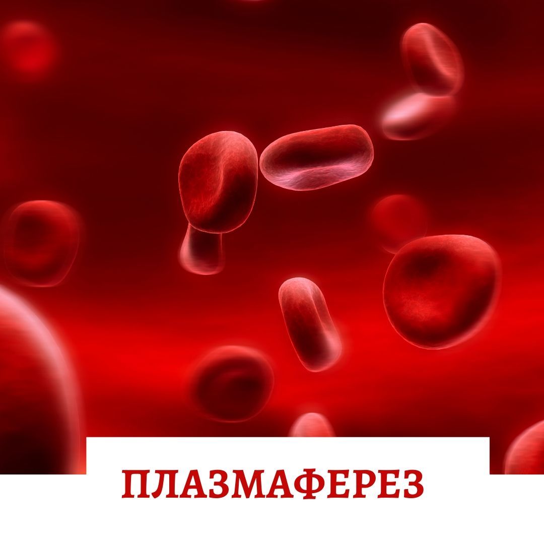 Плазмаферез